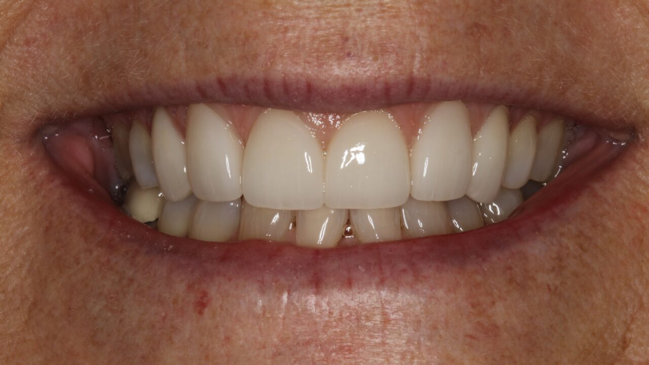 Smile Gallery | Brodie Dental